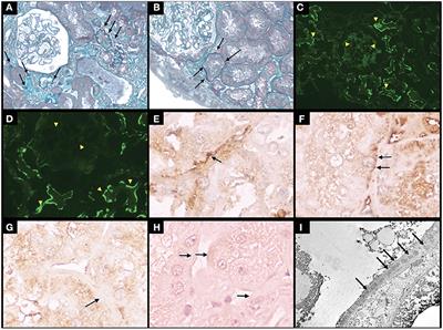 Case report: Isolated <mark class="highlighted">tubular basement membrane</mark> deposits in a patient with systemic lupus erythematosus - A diagnostic challenge